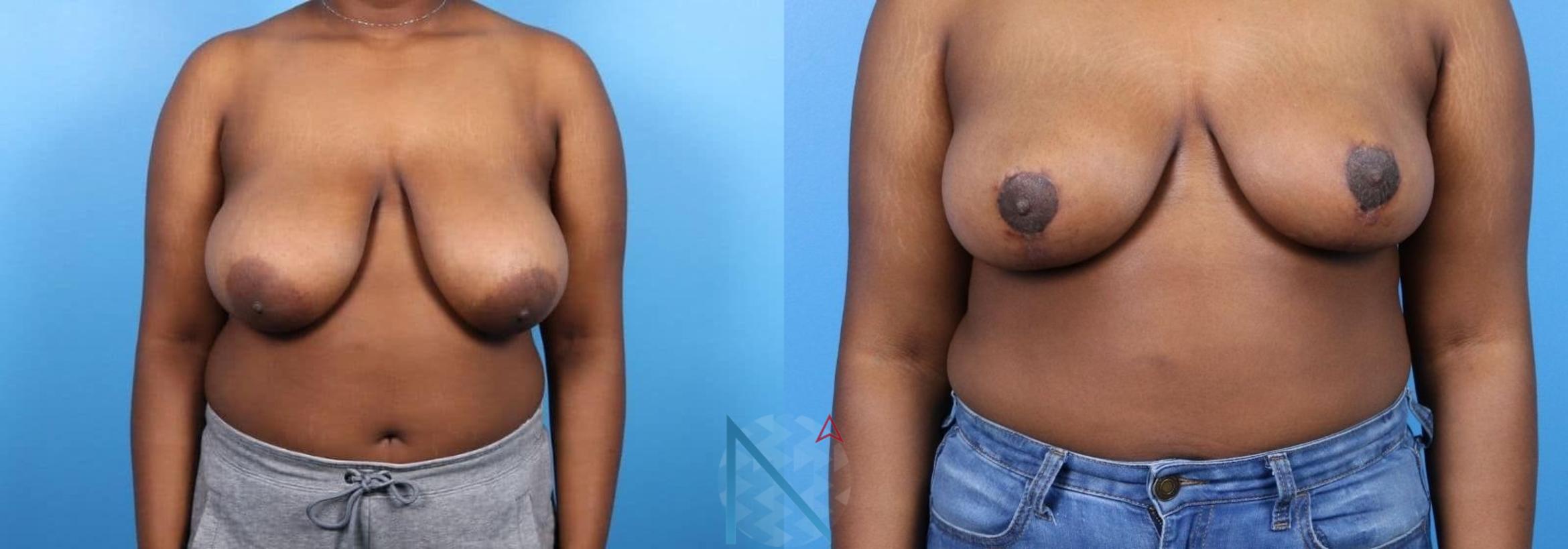 Before & After Breast Reduction Case 11 View 1 View in Raleigh, NC