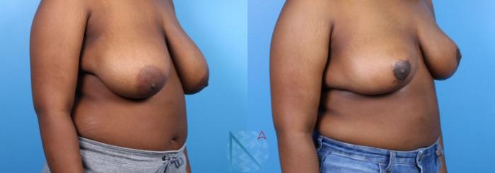 Before & After Breast Reduction Case 11 View 2 View in Raleigh, NC