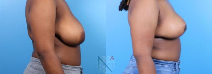 Before & After Breast Reduction Case 11 View 3 View in Raleigh, NC