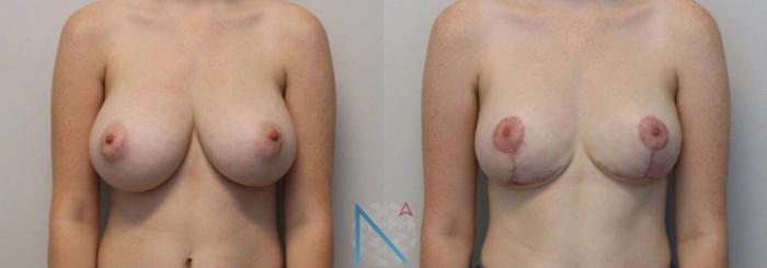 Before & After Breast Reduction Case 14 View 1 View in Raleigh, NC