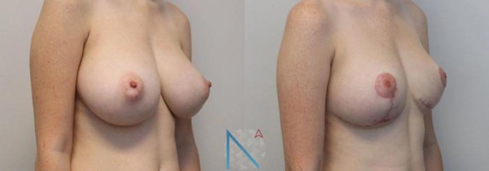 Before & After Breast Reduction Case 14 View 2 View in Raleigh, NC