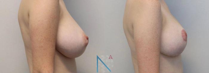 Before & After Breast Reduction Case 14 View 3 View in Raleigh, NC