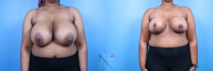 Before & After Breast Reduction Case 15 View 1 View in Raleigh, NC