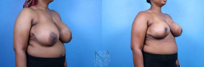 Before & After Breast Reduction Case 15 View 2 View in Raleigh, NC