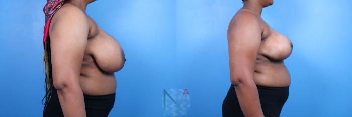 Before & After Breast Reduction Case 15 View 3 View in Raleigh, NC