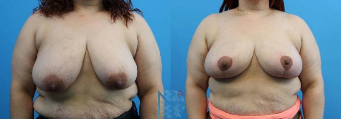 Before & After Breast Reduction Case 2 View 1 View in Raleigh, NC