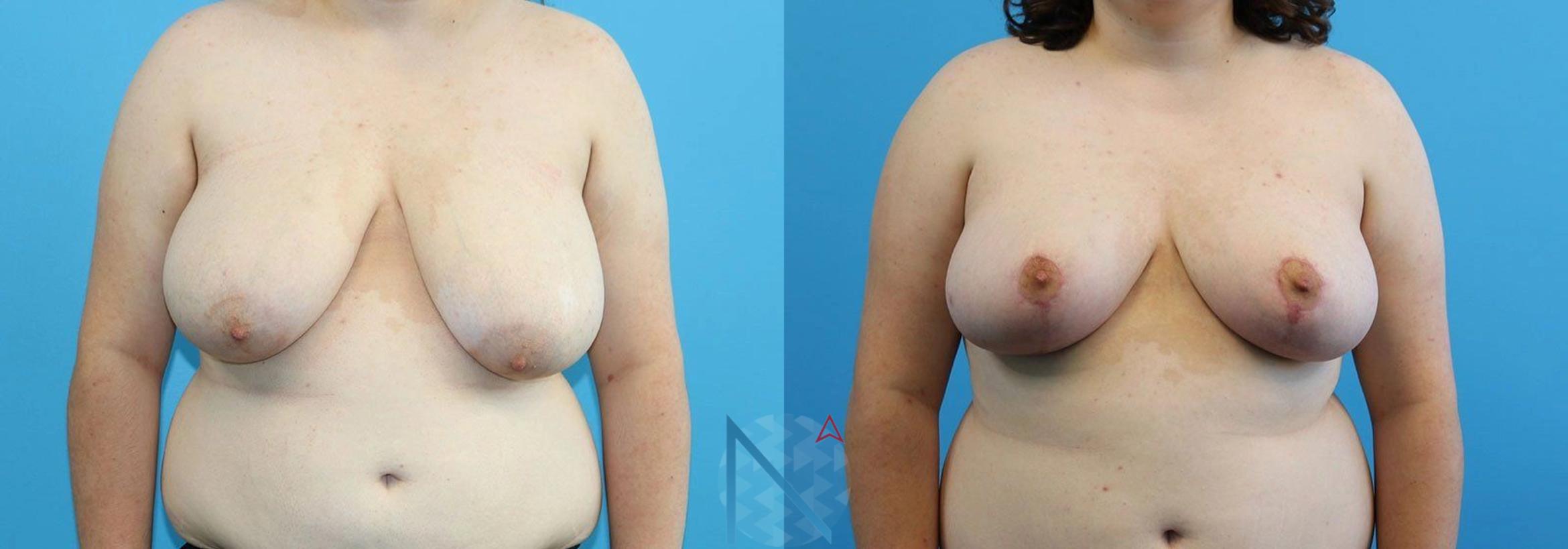 Before & After Breast Reduction Case 3 View 1 View in Raleigh, NC