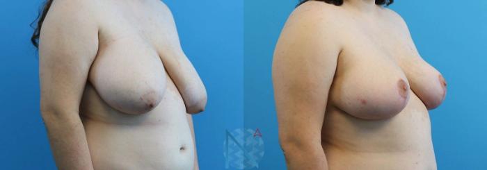 Before & After Breast Reduction Case 3 View 2 View in Raleigh, NC