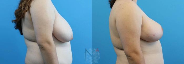 Before & After Breast Reduction Case 3 View 3 View in Raleigh, NC