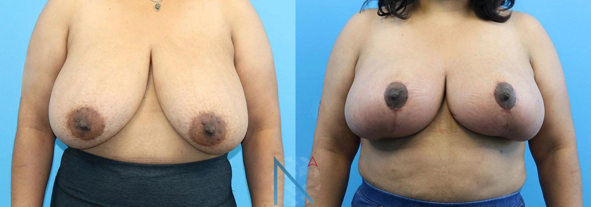 Before & After Breast Reduction Case 4 View 1 View in Raleigh, NC