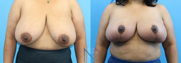 Before & After Breast Reduction Case 4 View 1 View in Raleigh, NC