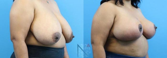 Before & After Breast Reduction Case 4 View 2 View in Raleigh, NC