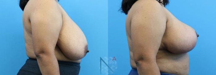 Before & After Breast Reduction Case 4 View 3 View in Raleigh, NC