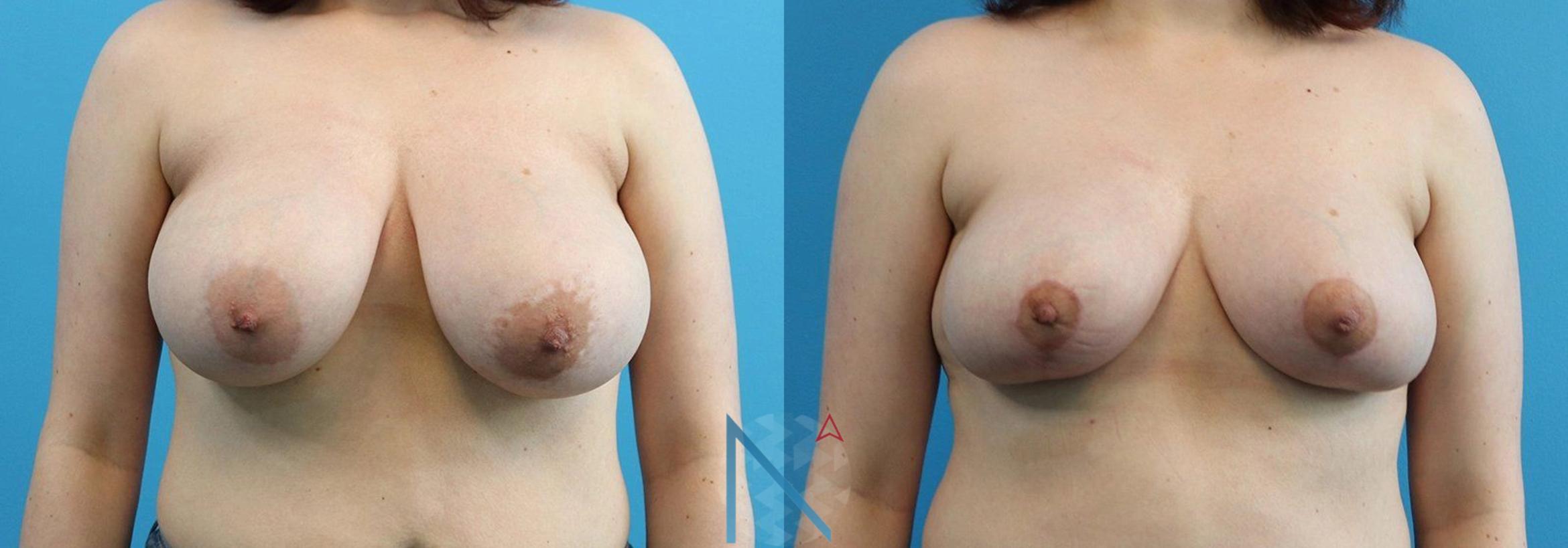 Before & After Breast Reduction Case 5 View 1 View in Raleigh, NC