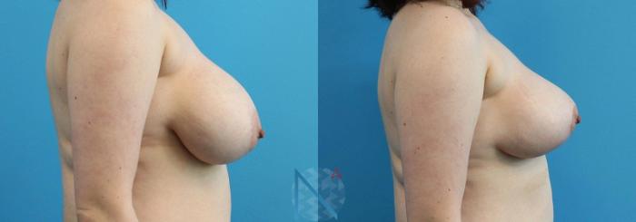 Before & After Breast Reduction Case 5 View 3 View in Raleigh, NC