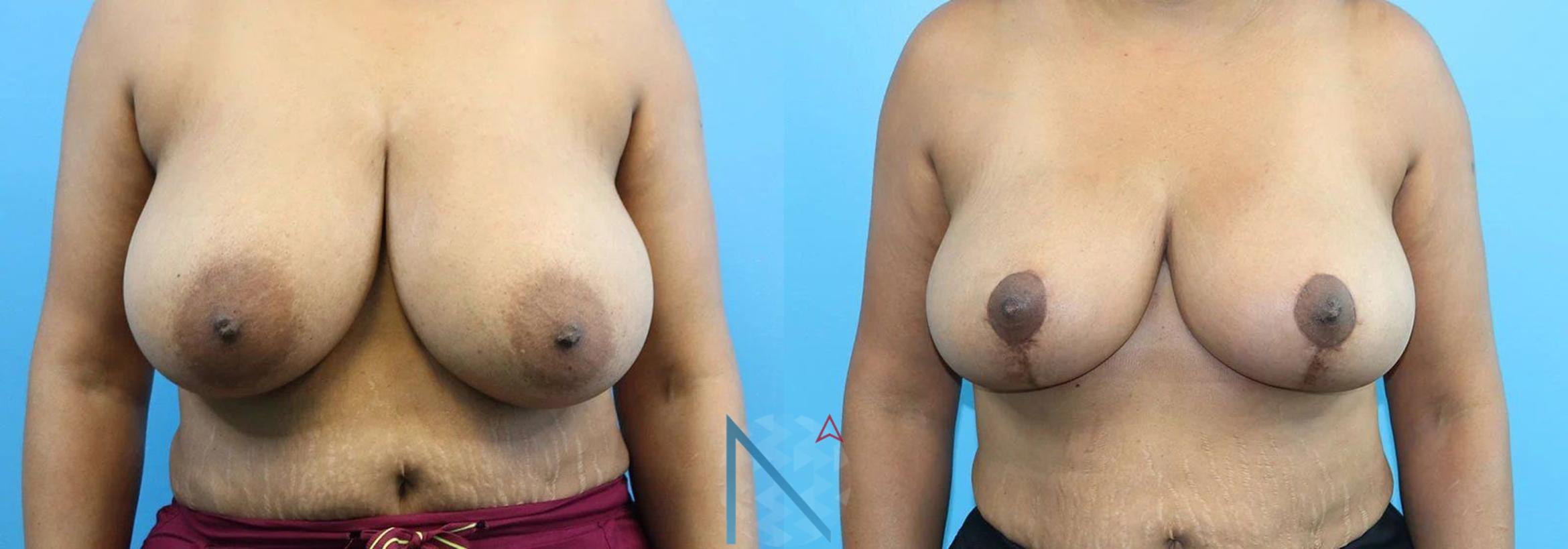 Before & After Breast Reduction Case 6 View 1 View in Raleigh, NC