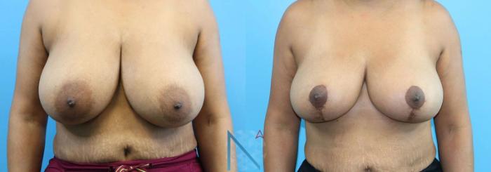 Before & After Breast Reduction Case 6 View 1 View in Raleigh, NC