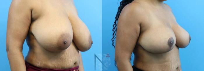 Before & After Breast Reduction Case 6 View 2 View in Raleigh, NC