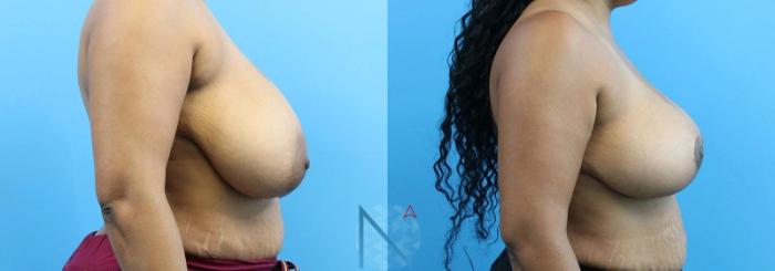 Before & After Breast Reduction Case 6 View 3 View in Raleigh, NC