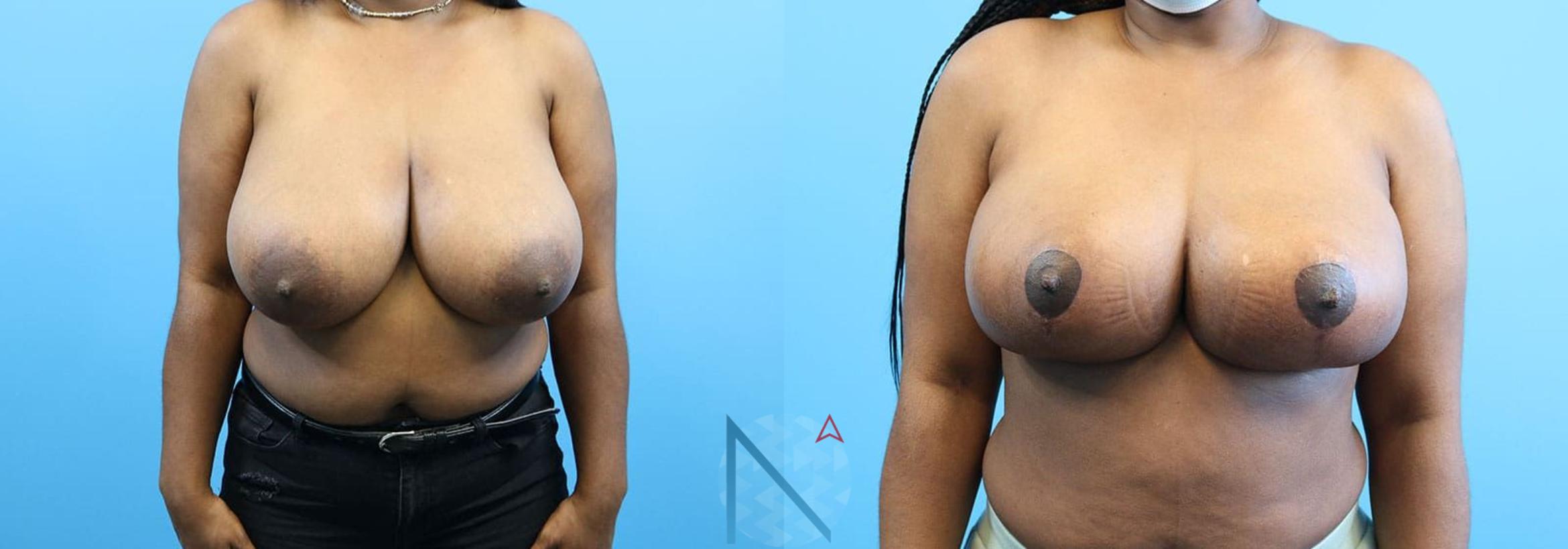 Before & After Breast Reduction Case 7 View 1 View in Raleigh, NC