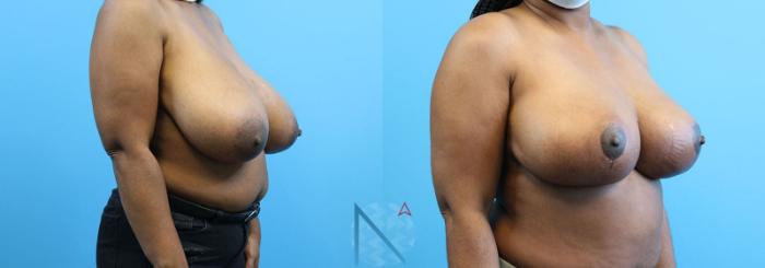 Before & After Breast Reduction Case 7 View 2 View in Raleigh, NC