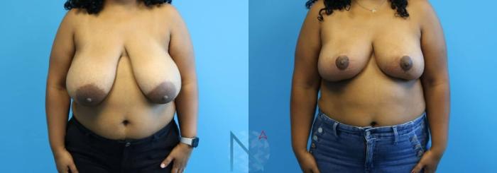 Before & After Breast Reduction Case 8 View 1 View in Raleigh, NC