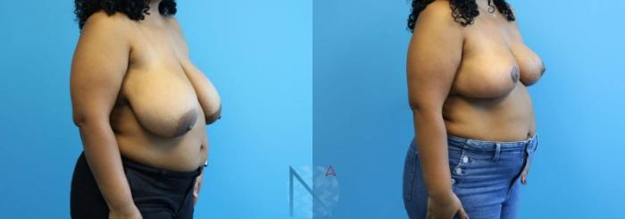 Before & After Breast Reduction Case 8 View 2 View in Raleigh, NC