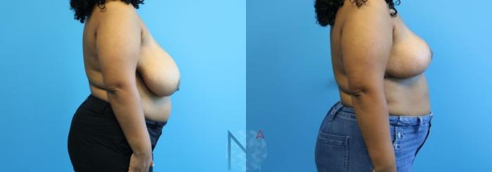 Before & After Breast Reduction Case 8 View 3 View in Raleigh, NC