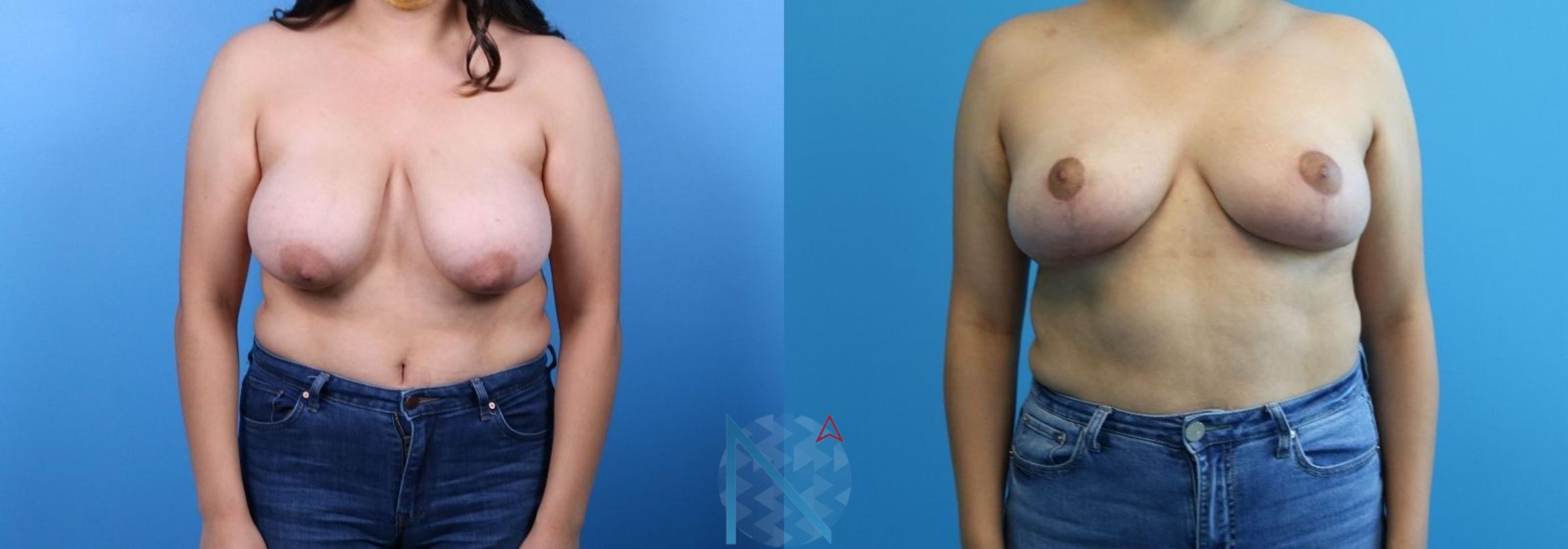 Before & After Breast Reduction Case 9 View 1 View in Raleigh, NC