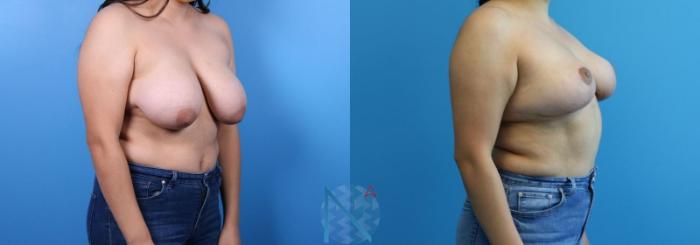 Before & After Breast Reduction Case 9 View 2 View in Raleigh, NC