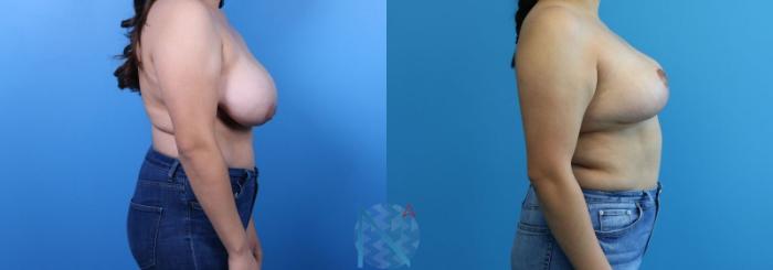 Before & After Breast Reduction Case 9 View 3 View in Raleigh, NC