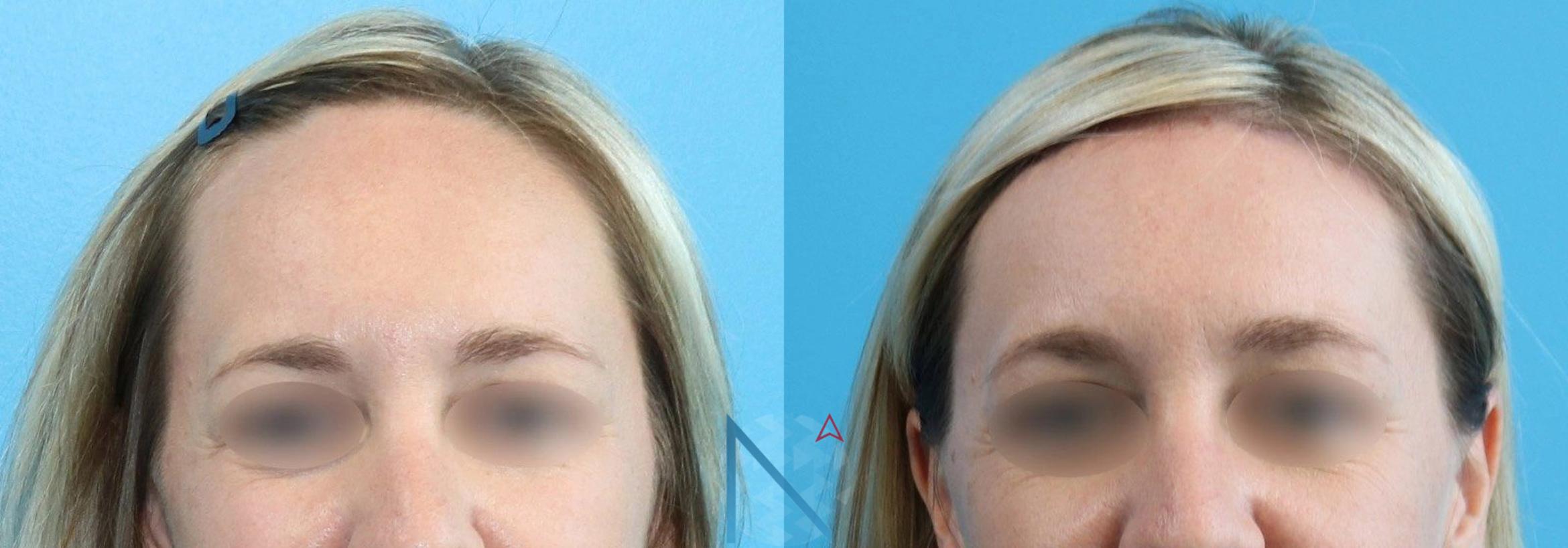 Before & After Forehead Reduction Case 151 View 1 View in Raleigh, NC