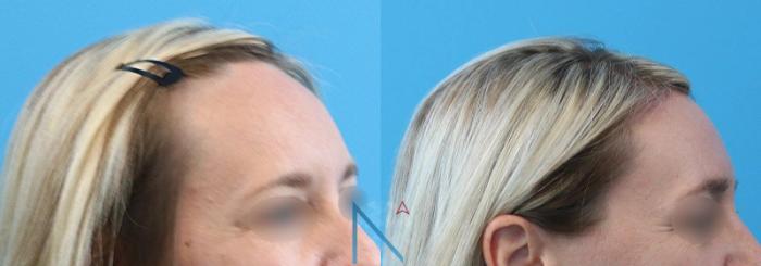 Before & After Forehead Reduction Case 151 View 2 View in Raleigh, NC