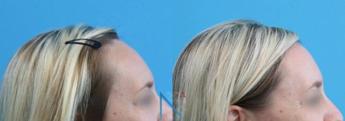 Before & After Forehead Reduction Case 151 View 3 View in Raleigh, NC