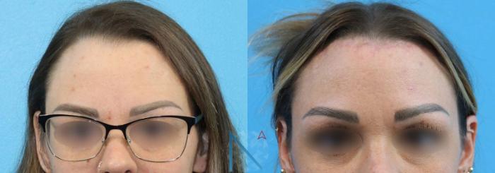 Before & After Forehead Reduction Case 152 View 1 View in Raleigh, NC