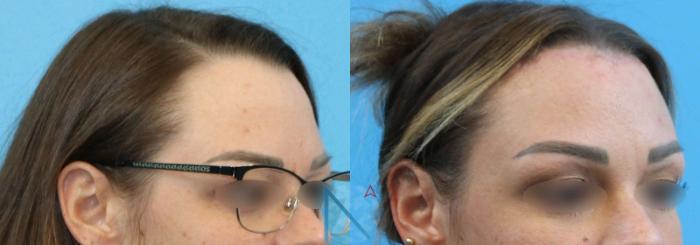 Before & After Forehead Reduction Case 152 View 2 View in Raleigh, NC