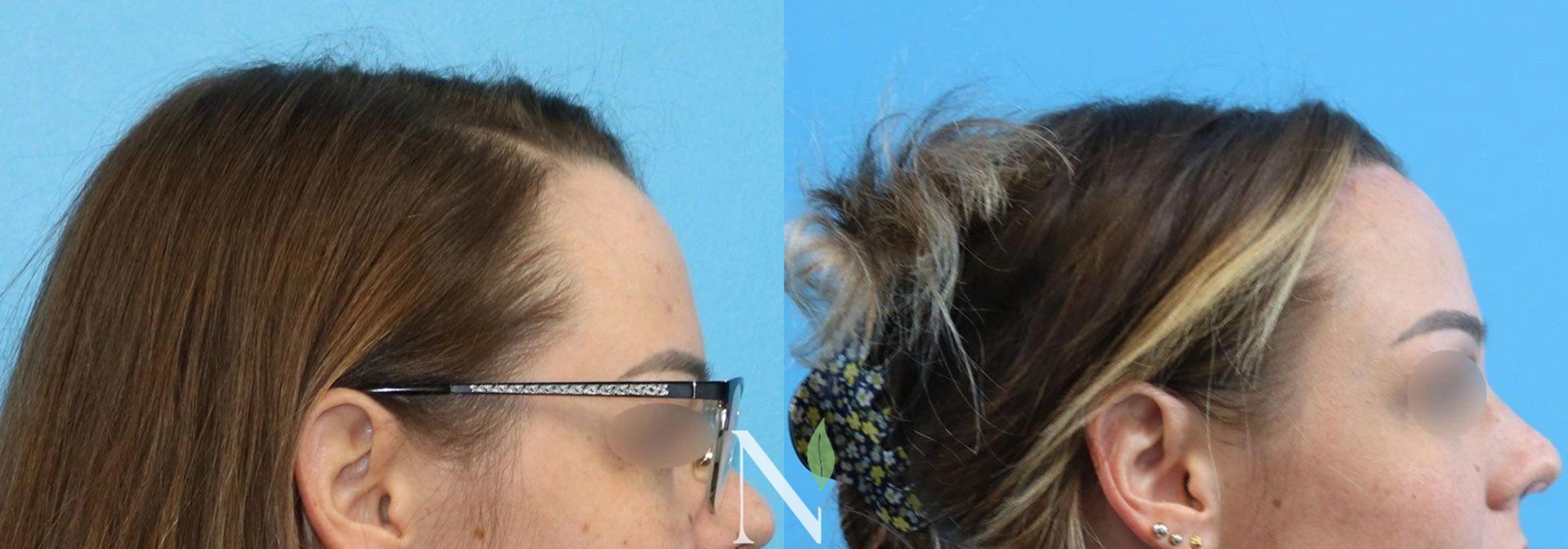 Forehead Reduction Before and After Pictures Case 152 | Raleigh, NC ...