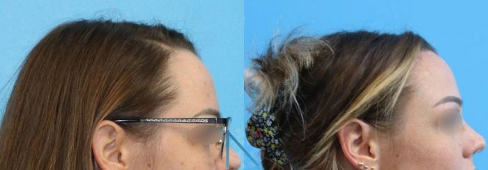 Before & After Forehead Reduction Case 152 View 3 View in Raleigh, NC