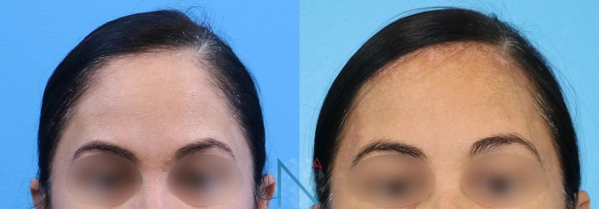 Before & After Forehead Reduction Case 153 View 1 View in Raleigh, NC