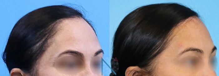 Before & After Forehead Reduction Case 153 View 2 View in Raleigh, NC