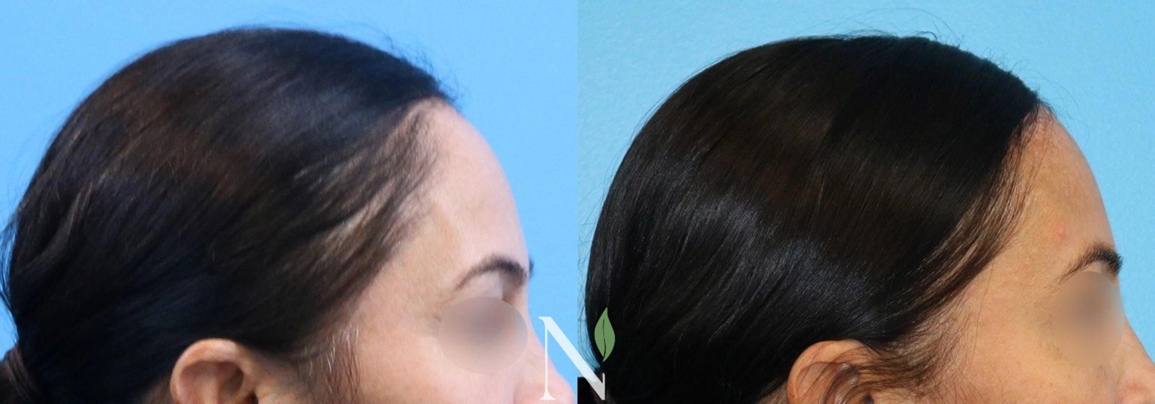 Reducing Forehead Forehead Reduction Before and After Pictures Case 153 | Raleigh, NC ...