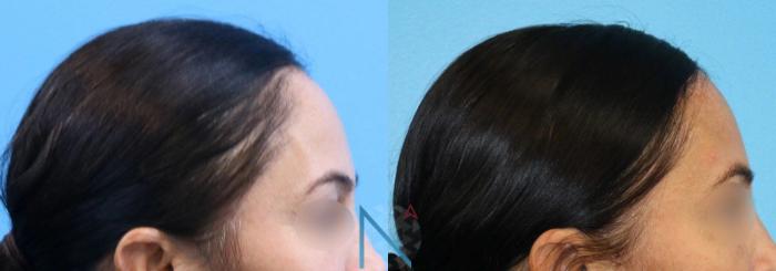 Before & After Forehead Reduction Case 153 View 3 View in Raleigh, NC