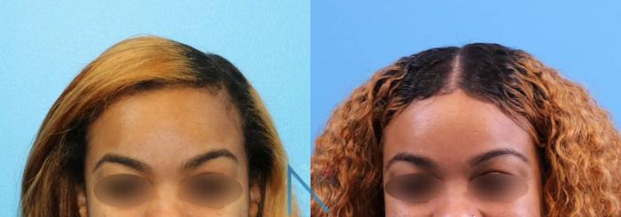 Before & After Forehead Reduction Case 154 View 1 View in Raleigh, NC