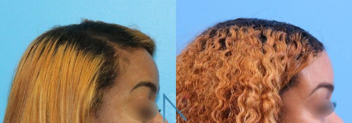 Before & After Forehead Reduction Case 154 View 2 View in Raleigh, NC