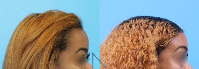 Before & After Forehead Reduction Case 154 View 3 View in Raleigh, NC