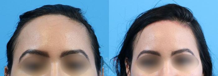 Before & After Forehead Reduction Case 155 View 1 View in Raleigh, NC