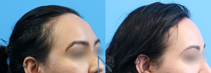 Before & After Forehead Reduction Case 155 View 2 View in Raleigh, NC