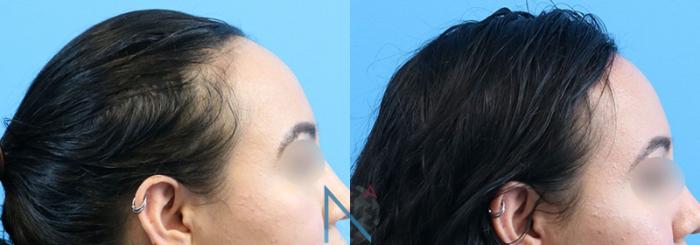 Before & After Forehead Reduction Case 155 View 3 View in Raleigh, NC