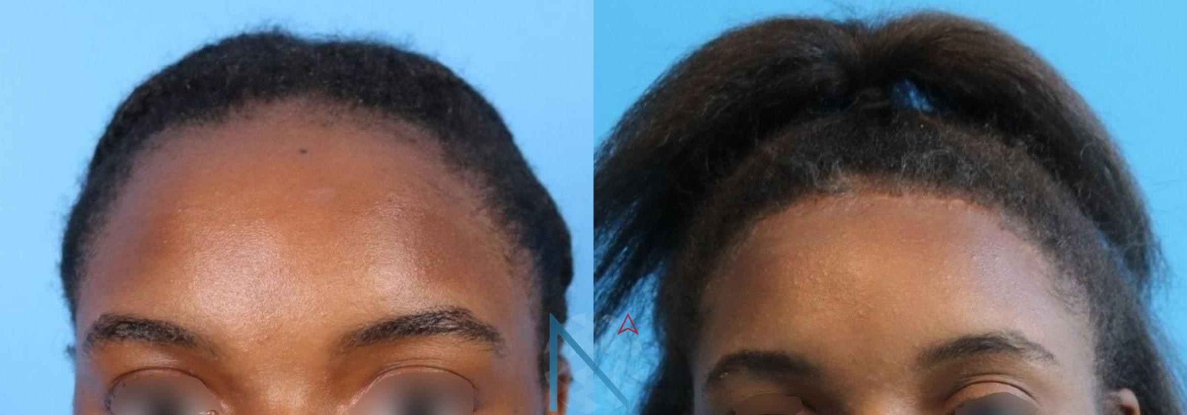 Before & After Forehead Reduction Case 156 View 1 View in Raleigh, NC