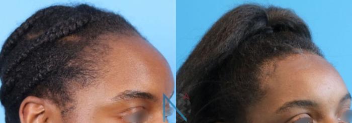 Before & After Forehead Reduction Case 156 View 2 View in Raleigh, NC